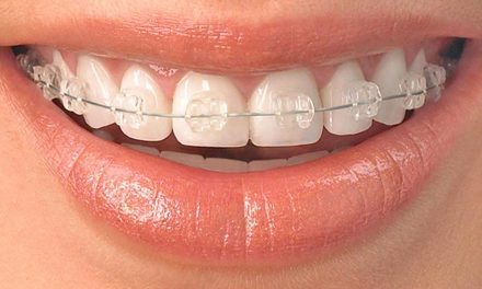 Short term orthodontics training with Quick Straight Teeth