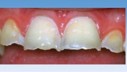 Deciphering toothwear and dental erosion at The Worn Dentition