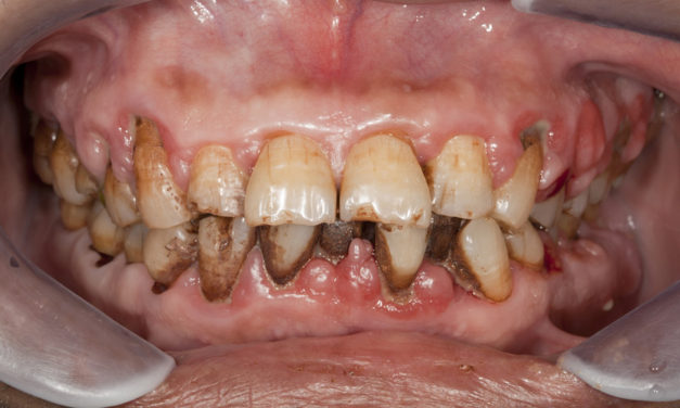 Research Finds Byproducts From Gum Disease Incite Oral Cancer Growth