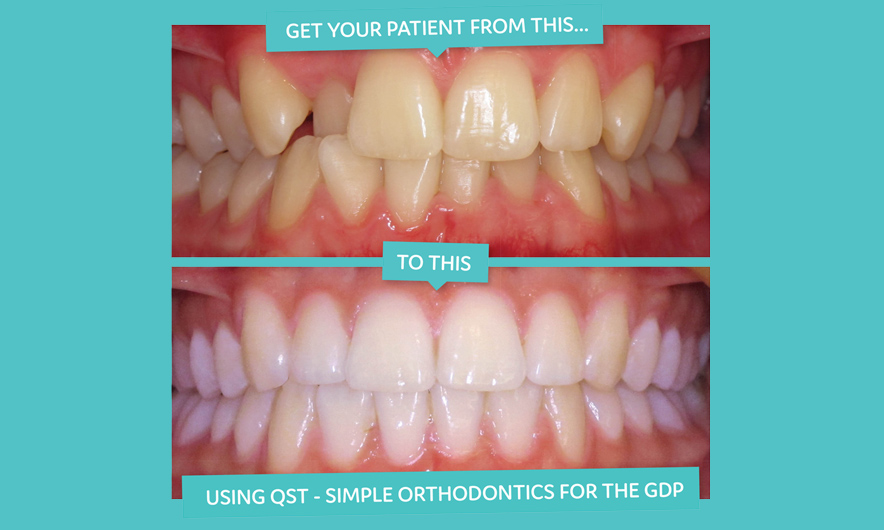 Learn short term orthodontics in 2017 with QST