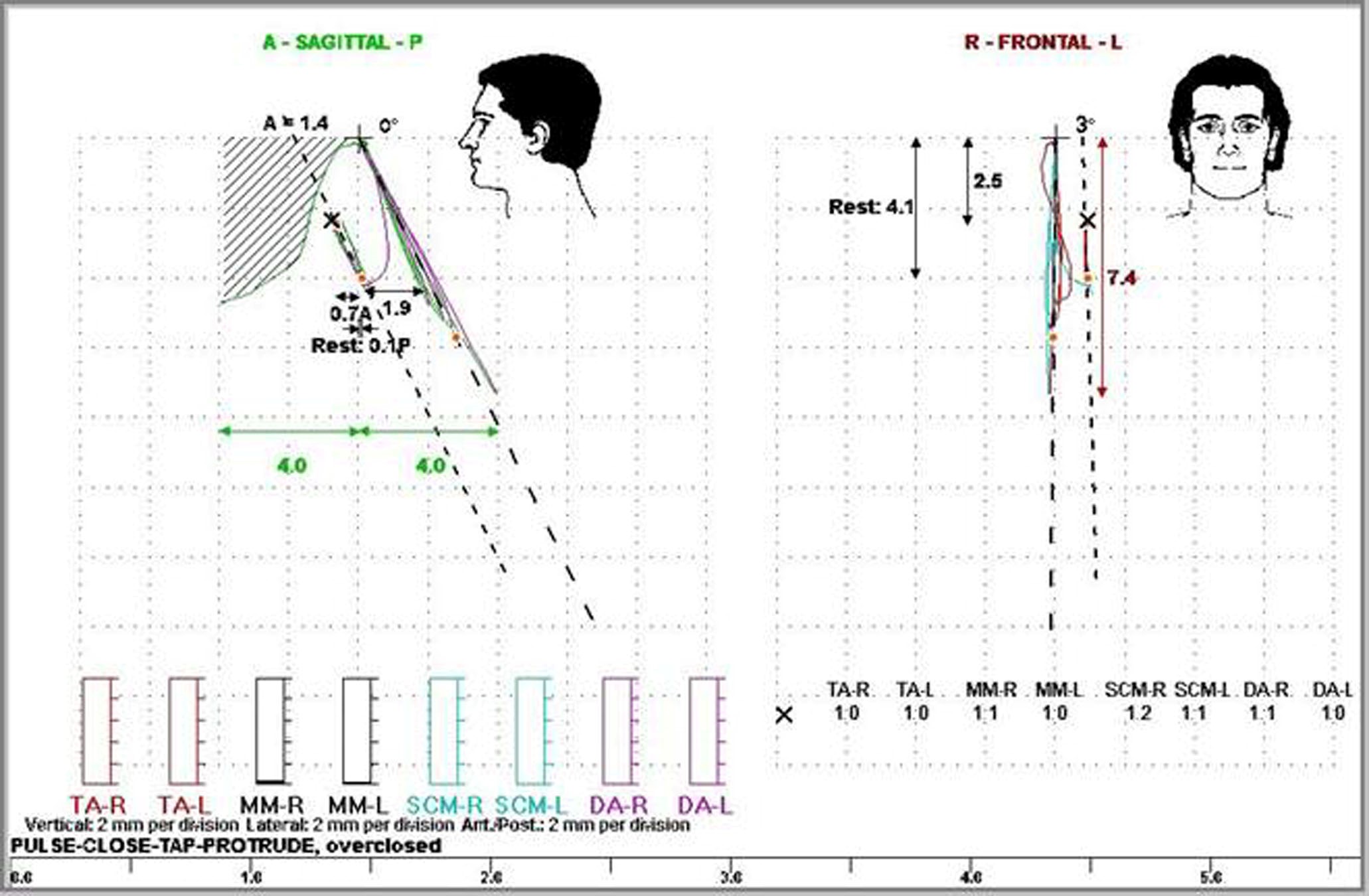 Diagram showing the increase in patient vertical dimension and reduction in freeway space