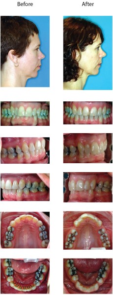 Photos of patient patient with an overclosed vertical dimension. Showing before and after corrective treatment