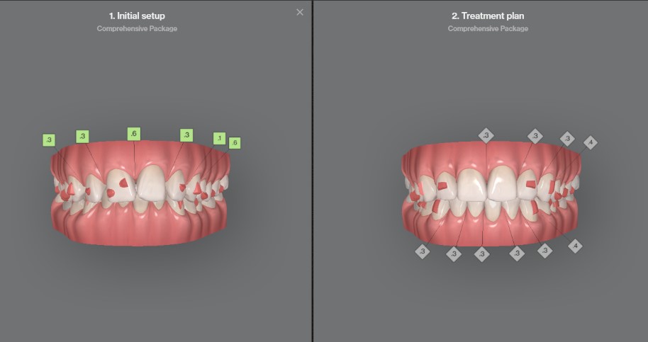 FitStrips by Garrison Dental