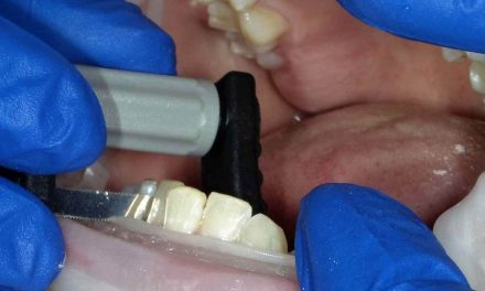 Interproximal Reduction Just Got More Predictable using FitStrips by Garrison Dental