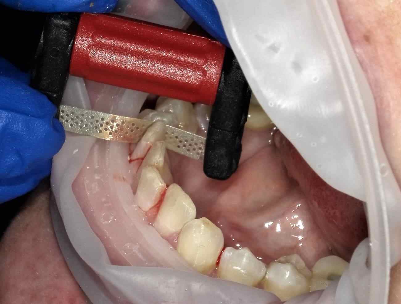 FitStrips by Garrison Dental