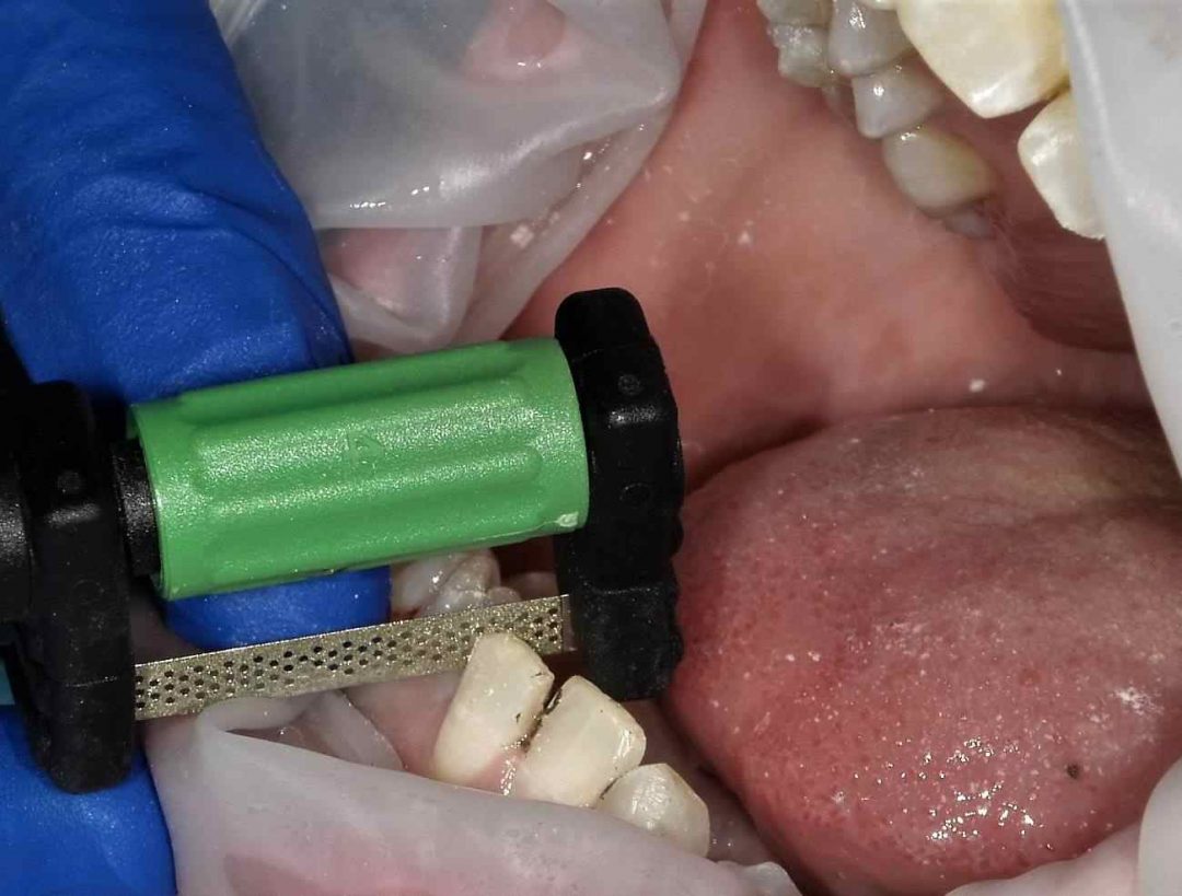 Interproximal Reduction Just Got More Predictable using FitStrips by